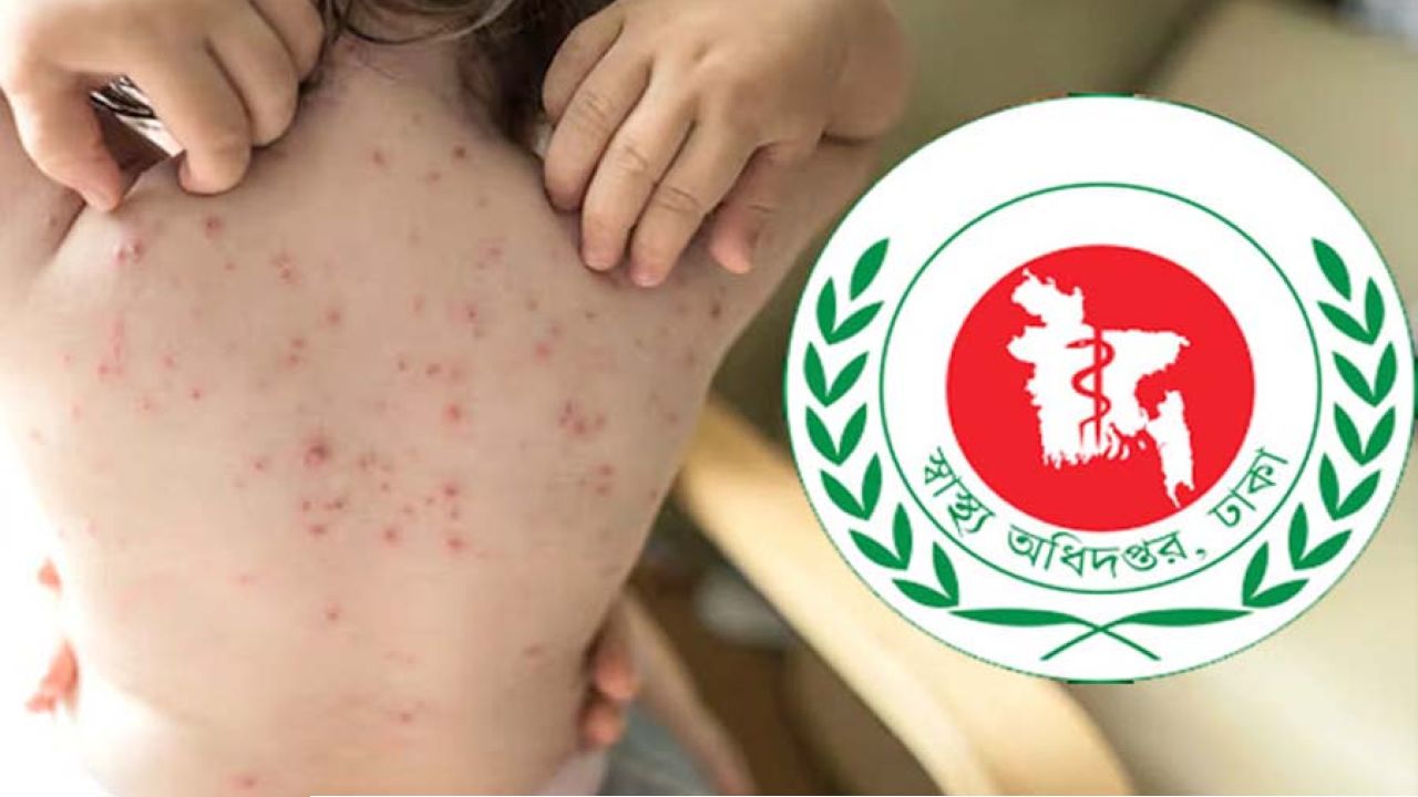 হাম ও উপসর্গ নিয়ে একদিনে ৭ শিশুর মৃত্যু