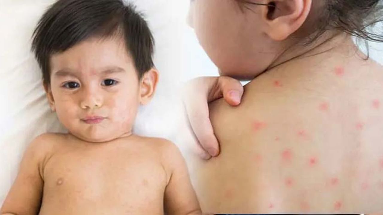 হাম ও উপসর্গে আরও ৭ শিশুর মৃত্যু