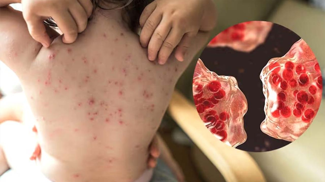 ২৪ ঘণ্টায় হাম আক্রান্ত ও উপসর্গ নিয়ে আরও ৯ জনের মৃত্যু