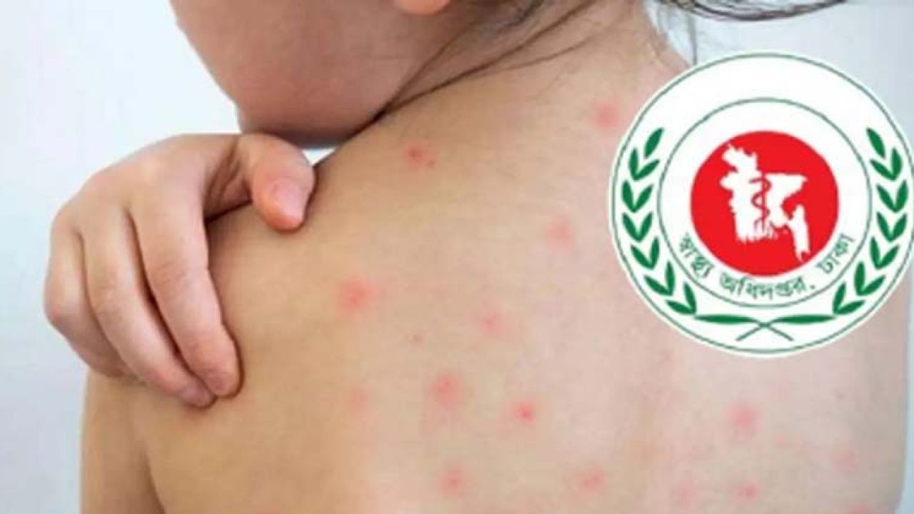 ২৪ ঘণ্টায় হাম সন্দেহে আরও ৪ শিশুর মৃত্যু