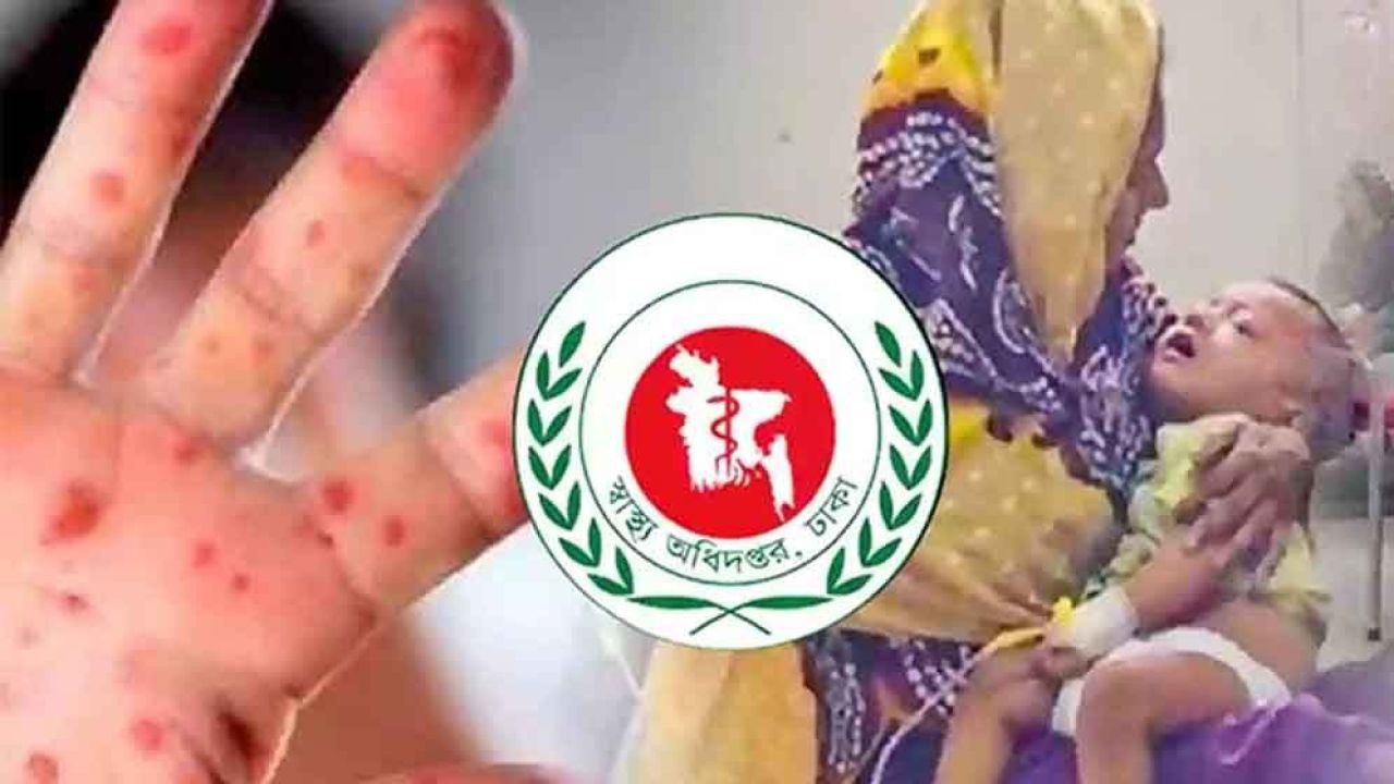 হাম উপসর্গে আরও ৫ শিশুর মৃত্যু