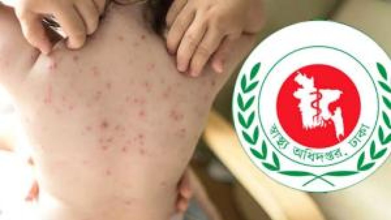 ২৪ ঘণ্টায় হাম ও উপসর্গে ১১ জনের মৃত্যু