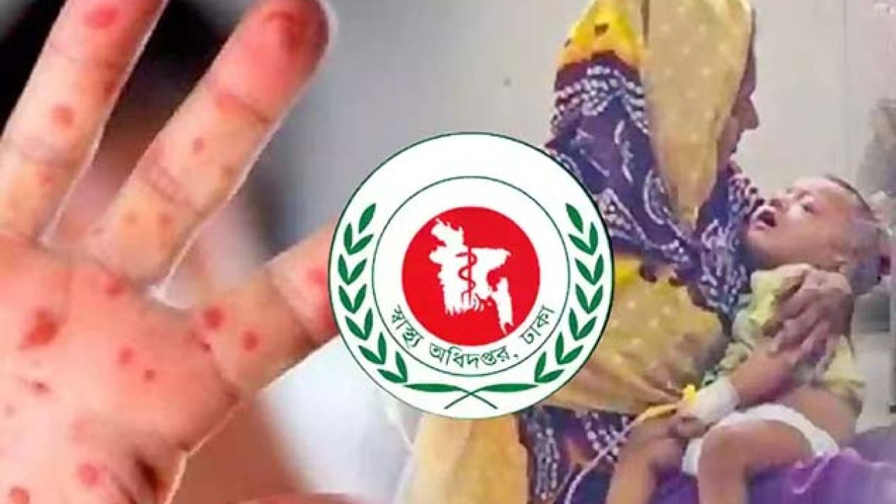 হাম ও উপসর্গ নিয়ে আরও ৮ শিশুর মৃত্যু