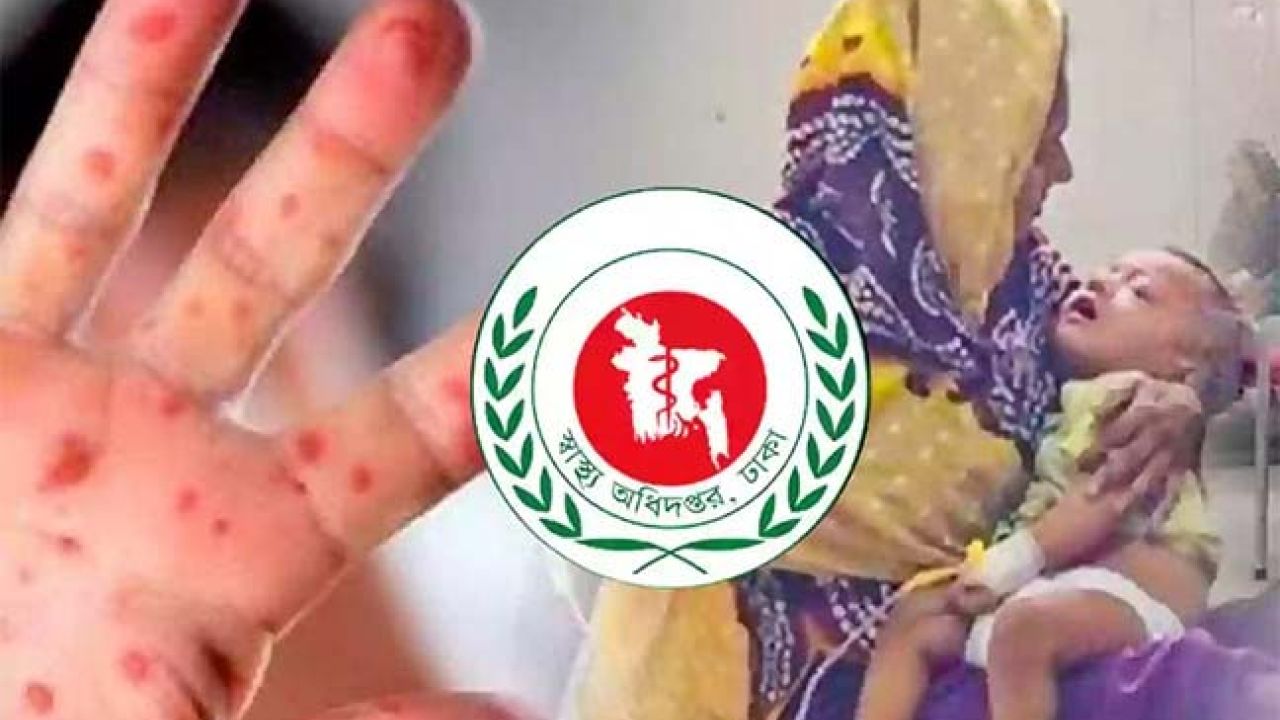 হামের উপসর্গে আরও ৪ শিশুর মৃত্যু
