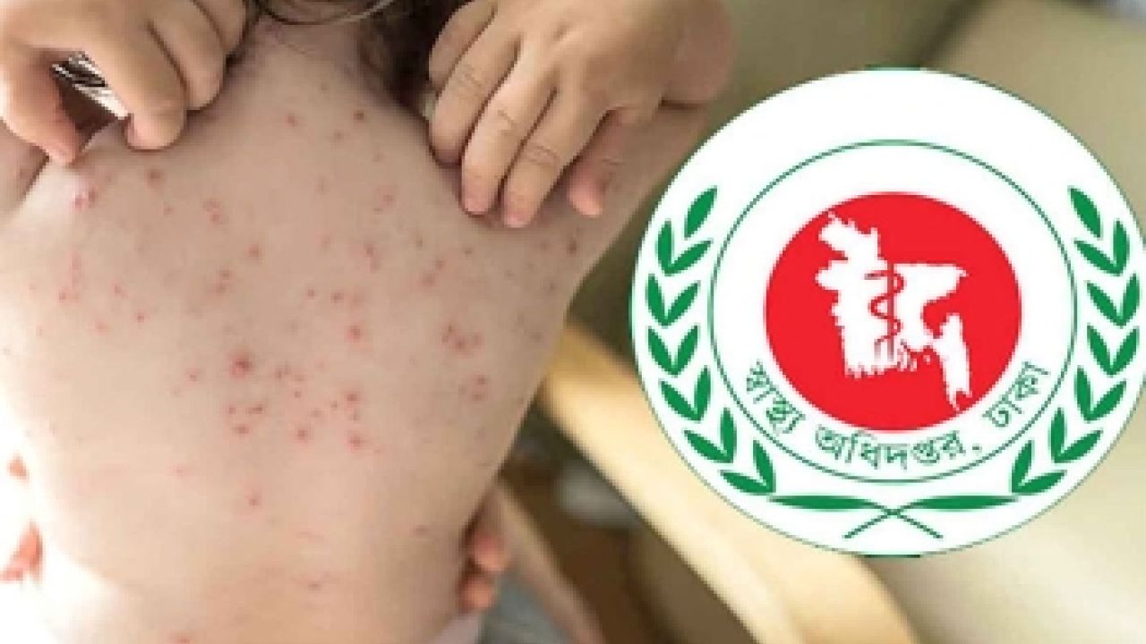 হাম ও উপসর্গে এক দিনে সর্বাধিক ১৭ শিশুর মৃত্যু