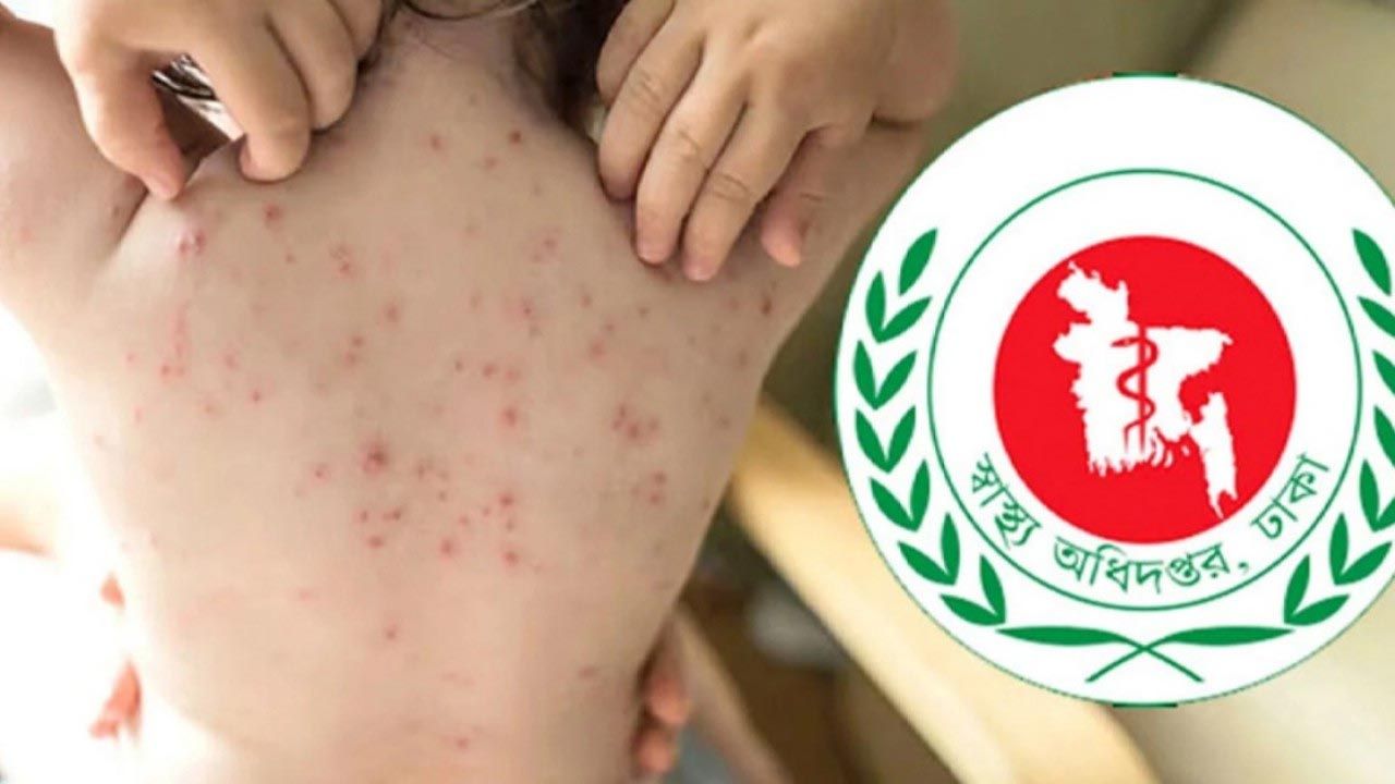 ২৪ ঘণ্টায় হাম ও উপসর্গে ১১ শিশুর মৃত্যু