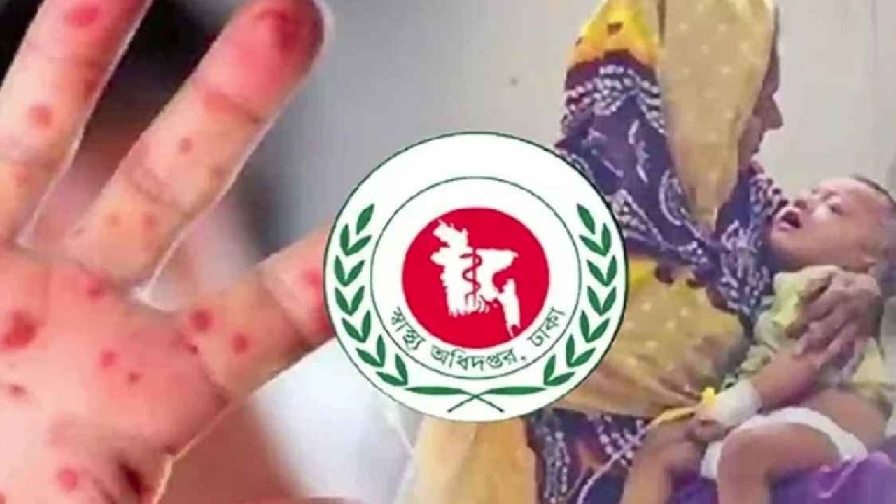 হাম উপসর্গে আরও ৫ শিশুর মৃত্যু