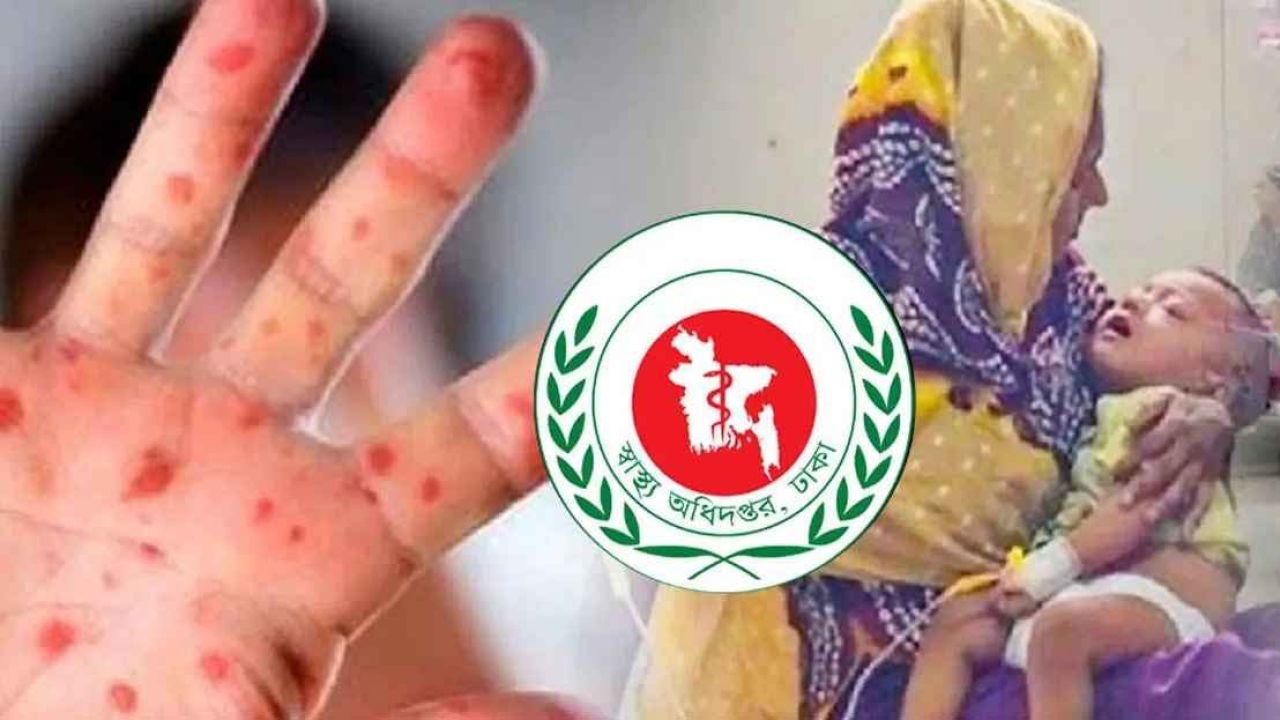 হাম উপসর্গে আরও ৫ শিশুর মৃত্যু