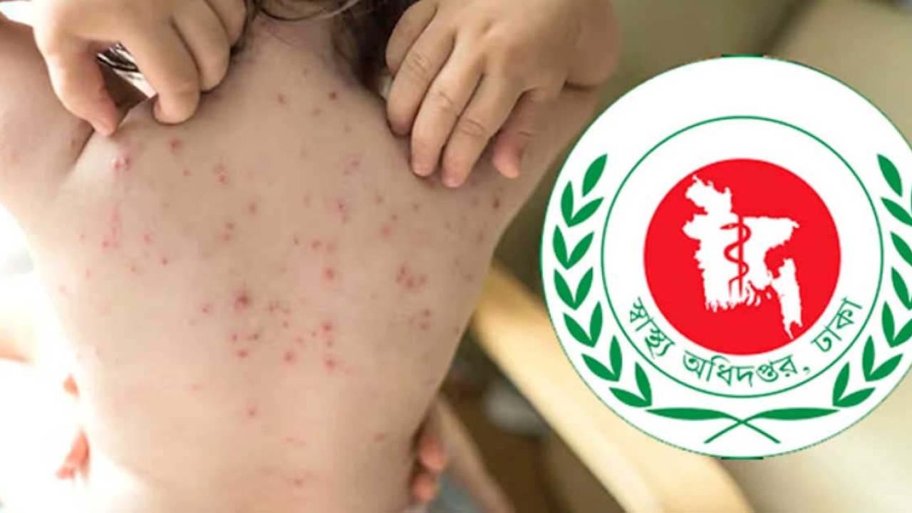হাম উপসর্গে ২৪ ঘণ্টায় ৪ শিশুর মৃত্যু