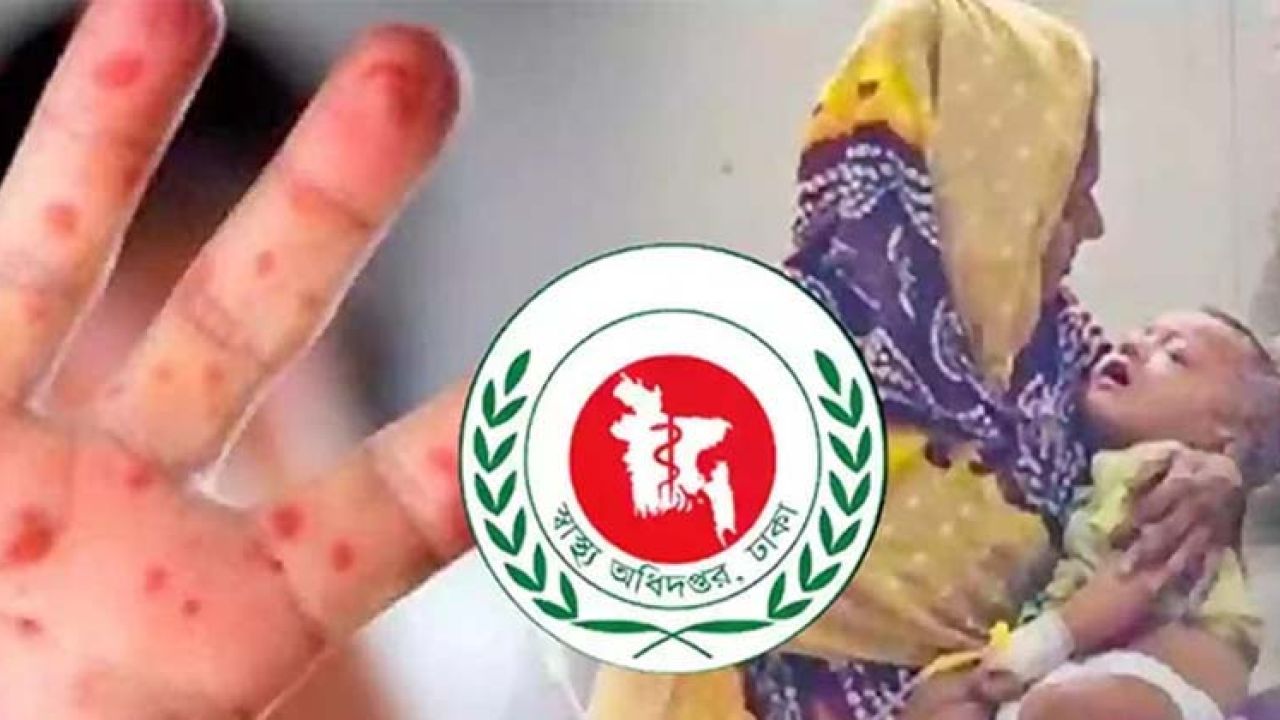 একদিনে হামের উপসর্গে আরও ৩ শিশুর মৃত্যু