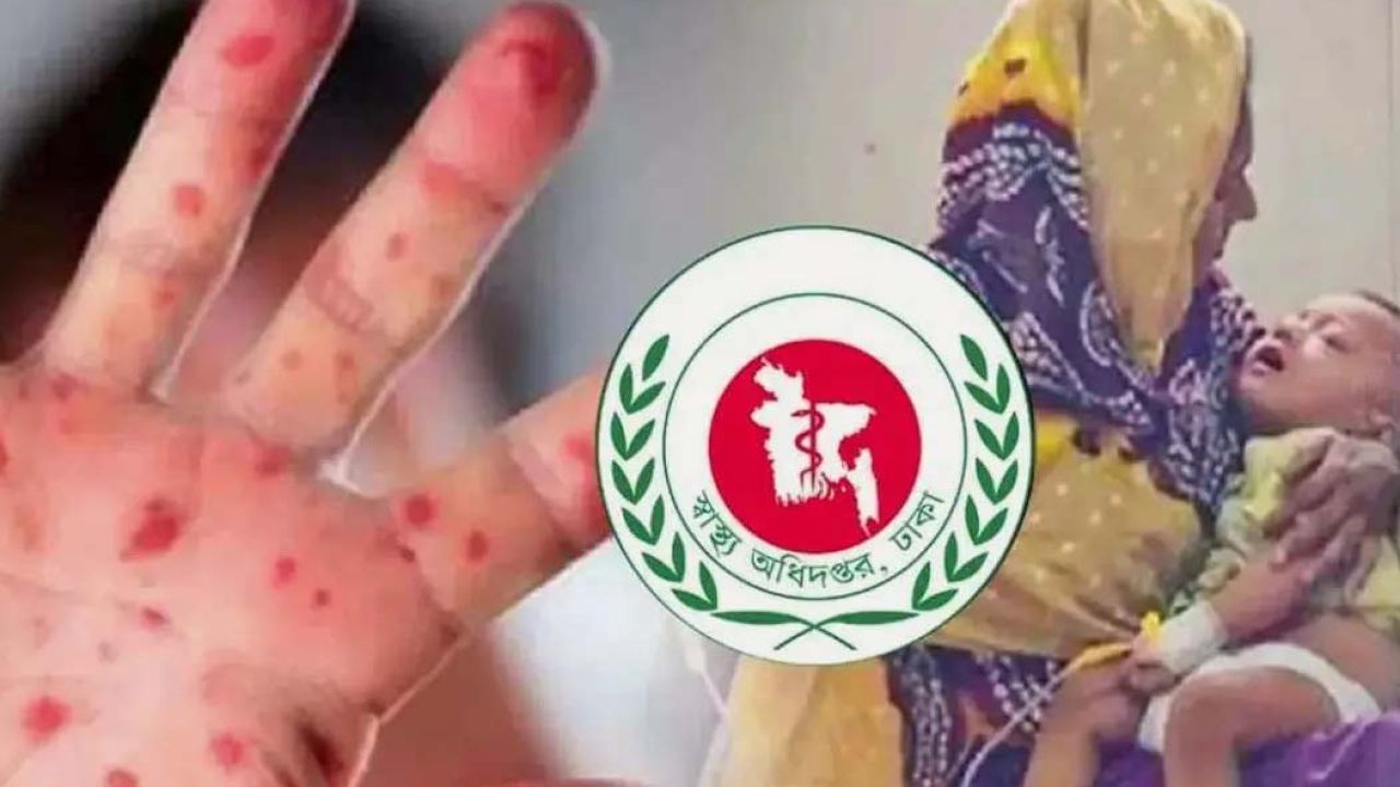 হাম ও উপসর্গে আরও ৫ শিশুর মৃত্যু