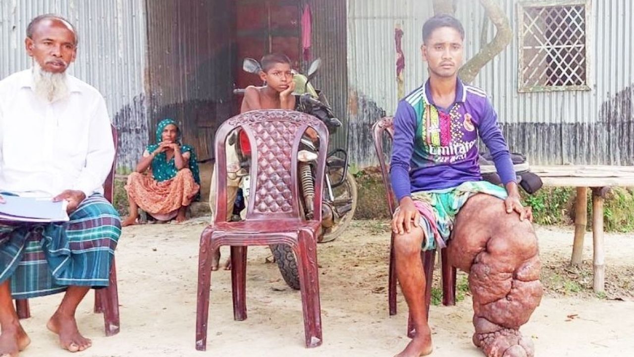 আবু বক্কর ১৭ বছর পায়ের ভারে বন্দি, অর্থাভাবে থমকে আছে চিকিৎসা