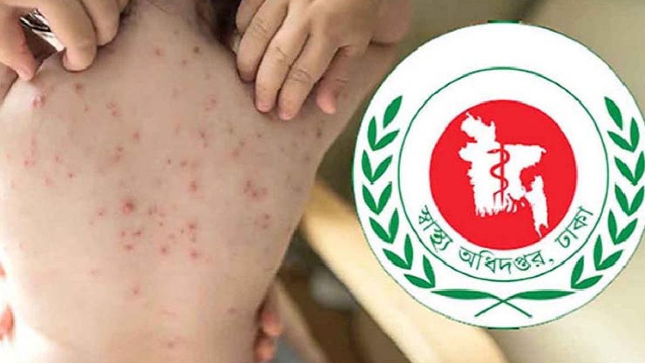 হাম উপসর্গে আরও ৪ শিশুর মৃত্যু