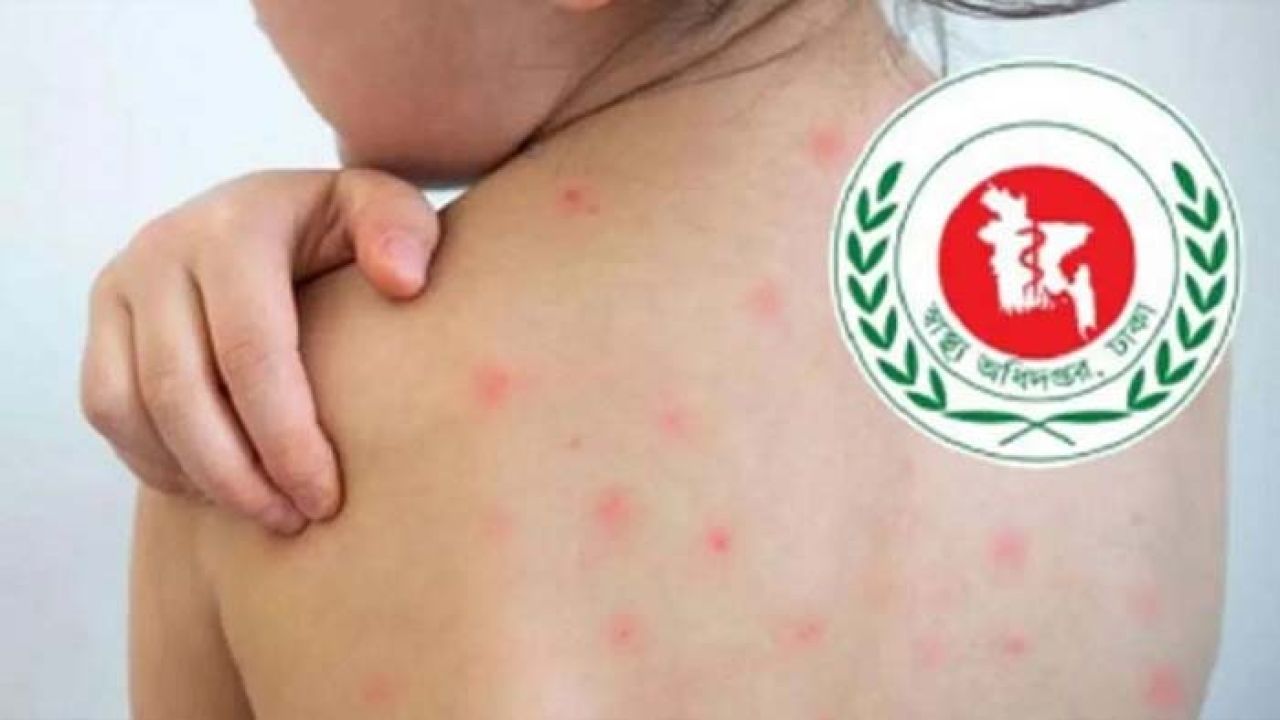 হাম ও উপসর্গে আরও ৪ জনের মৃত্যু