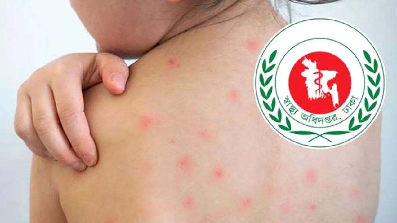 হাম ও উপসর্গে প্রাণ গেল আরও ৪ জনের