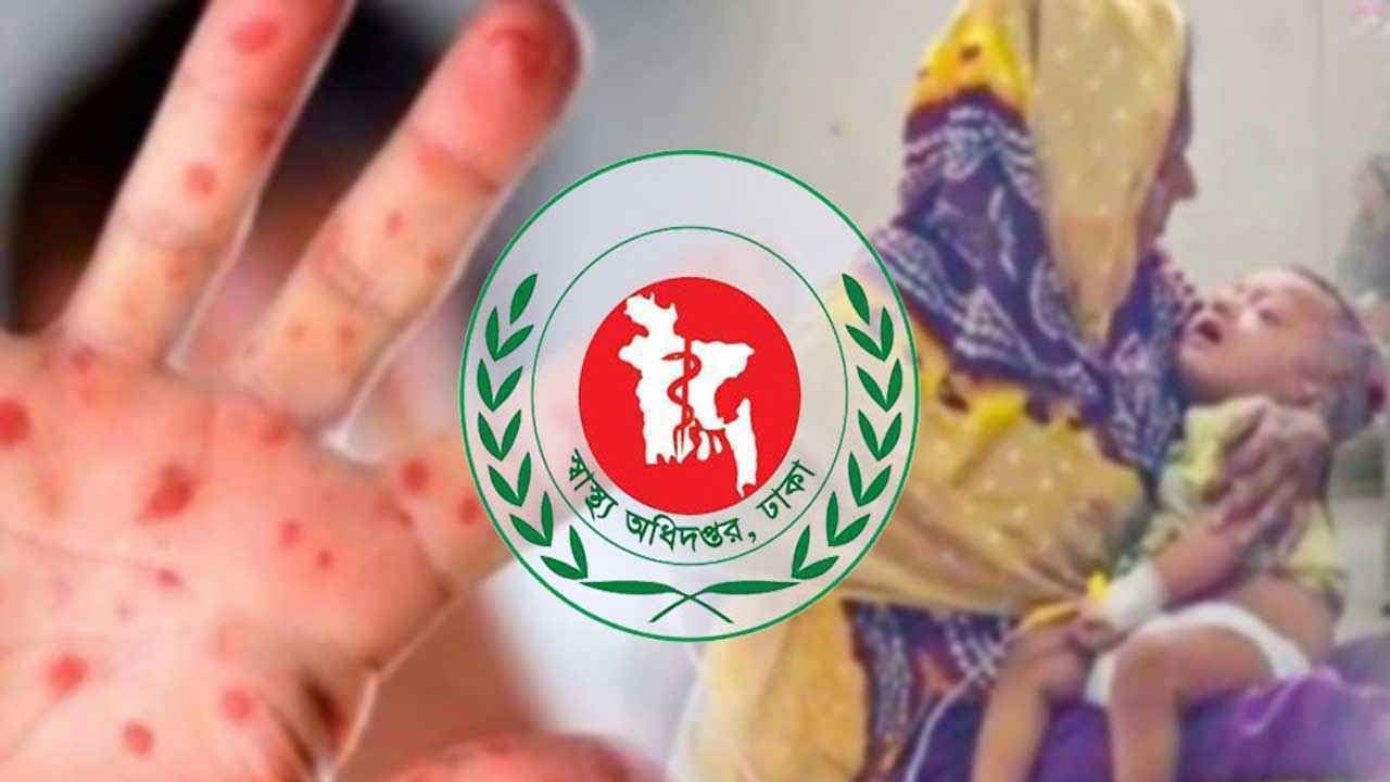 হাম উপসর্গে আরও ৭ শিশুর মৃত্যু, নতুন আক্রান্ত ৮৫৫