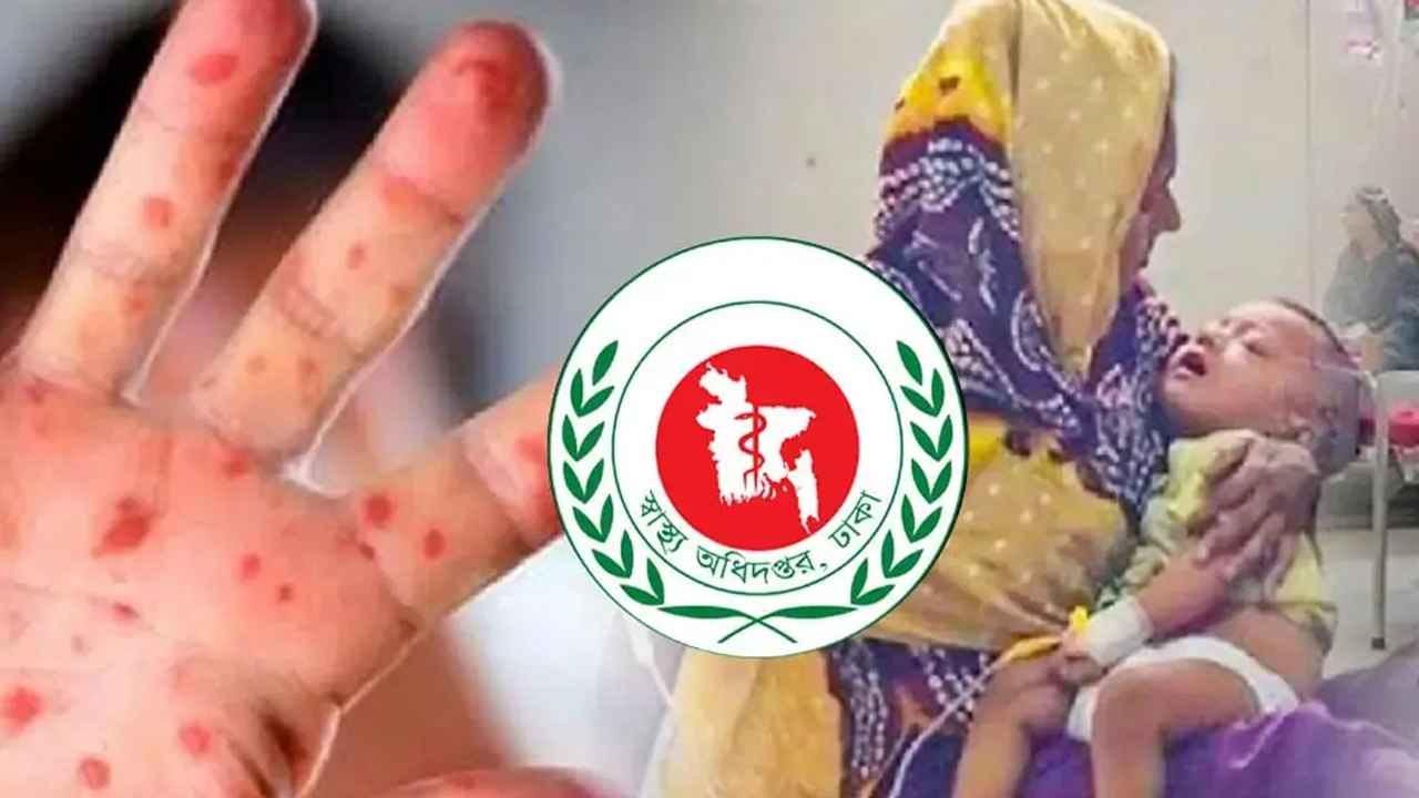 হাম উপসর্গে আরও ৭ শিশুর মৃত্যু